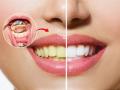Know Simple Home Remedies For Teeth Whitening - Hindi News | Know Simple Home Remedies For Teeth Whitening | Latest lifestyle News at Lokmattimes.com