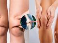 How to Reduce Knee Fat Naturally, Exercises for Toned and Strong Knees - Hindi News | How to Reduce Knee Fat Naturally, Exercises for Toned and Strong Knees | Latest lifestyle News at Lokmattimes.com