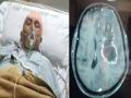 Indore: Doctors remove largest white fungus from woman's brain - Hindi News | Indore: Doctors remove largest white fungus from woman's brain | Latest national News at Lokmattimes.com