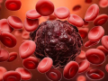 Different Types of Blood Cancer & Early Warning Signs - Hindi News | Different Types of Blood Cancer & Early Warning Signs | Latest health News at Lokmattimes.com