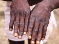 Monkeypox-infected US citizen escapes from Mexican hospital - Hindi News | Monkeypox-infected US citizen escapes from Mexican hospital | Latest international News at Lokmattimes.com