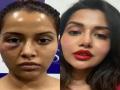 Actor Raiza Wilson's surgery goes horribly wrong, blames dermatologist for ruining her face - Hindi News | Actor Raiza Wilson's surgery goes horribly wrong, blames dermatologist for ruining her face | Latest entertainment News at Lokmattimes.com