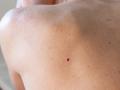 What Are Red Moles on Skin? Understanding Cherry Angiomas and Their Causes - Hindi News | What Are Red Moles on Skin? Understanding Cherry Angiomas and Their Causes | Latest health News at Lokmattimes.com