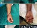 37-year-old Woman’s Hand Reattached in an 8-hour-Long Surgery - Hindi News | 37-year-old Woman’s Hand Reattached in an 8-hour-Long Surgery | Latest national News at Lokmattimes.com