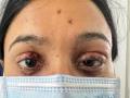 Pune Firecracker Mishap: Engineering Student Suffers Eye Burns While Celebrating Diwali - Hindi News | Pune Firecracker Mishap: Engineering Student Suffers Eye Burns While Celebrating Diwali | Latest pune News at Lokmattimes.com