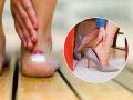 How to Treat Shoe Bites: Simple Home Remedies for Blisters - Hindi News | How to Treat Shoe Bites: Simple Home Remedies for Blisters | Latest lifestyle News at Lokmattimes.com