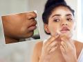 Skin Health: White Spots on Face? 5 Home Remedies to Get Quick Relief from Itching and Skin Whitening - Hindi News | Skin Health: White Spots on Face? 5 Home Remedies to Get Quick Relief from Itching and Skin Whitening | Latest health News at Lokmattimes.com