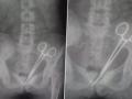 Madhya Pradesh Shocker: Woman Discovers Surgical Scissors Left Inside Her Body Two Years After Cancer Treatment - Hindi News | Madhya Pradesh Shocker: Woman Discovers Surgical Scissors Left Inside Her Body Two Years After Cancer Treatment | Latest national News at Lokmattimes.com