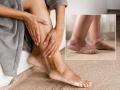 Do Your Feet Swell Often? It May Not Be Fatigue Here’s What Your Body Is Trying to Tell You - Hindi News | Do Your Feet Swell Often? It May Not Be Fatigue Here’s What Your Body Is Trying to Tell You | Latest lifestyle News at Lokmattimes.com