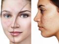 What is cystic acne? Check out the home remedies to reduce Cystic Acne - Hindi News | What is cystic acne? Check out the home remedies to reduce Cystic Acne | Latest lifestyle News at Lokmattimes.com
