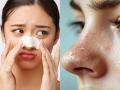 Skincare Tips: 4 Effective Home Remedies to Remove Whiteheads for Clear, Glowing Skin - Hindi News | Skincare Tips: 4 Effective Home Remedies to Remove Whiteheads for Clear, Glowing Skin | Latest lifestyle News at Lokmattimes.com