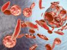 Anemia Symptoms: How to Recognize Low Hemoglobin Levels in Your Body | Latest health Photos at www.lokmattimes.com Anemia Symptoms: How to Recognize Low Hemoglobin Levels in Your Body | Latest health Photos at www.lokmattimes.com