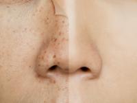 Want Glowing Skin by Eid? Try These Easy Pigmentation Reducing Face Packs For 29 Days of Ramzaan - News | Want Glowing Skin by Eid? Try These Easy Pigmentation Reducing Face Packs For 29 Days of Ramzaan | Latest lifestyle News at Lokmattimes.com