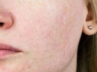 Struggling With Dull Winter Skin? Try These 5 Simple Indian Superfoods - News | Struggling With Dull Winter Skin? Try These 5 Simple Indian Superfoods | Latest health News at Lokmattimes.com Struggling With Dull Winter Skin? Try These 5 Simple Indian Superfoods - News | Struggling With Dull Winter Skin? Try These 5 Simple Indian Superfoods | Latest health News at Lokmattimes.com