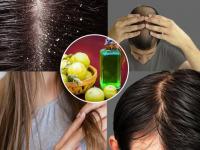 Hair Fall in Winter? Make This Simple Homemade Amla Oil for Strong, Shiny Hair - News | Hair Fall in Winter? Make This Simple Homemade Amla Oil for Strong, Shiny Hair | Latest lifestyle News at Lokmattimes.com