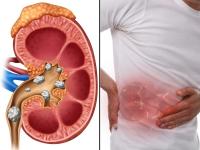 Mumbai Rains Cause Spike in Kidney Stone Cases, Doctors Caution - News | Mumbai Rains Cause Spike in Kidney Stone Cases, Doctors Caution | Latest mumbai News at Lokmattimes.com Mumbai Rains Cause Spike in Kidney Stone Cases, Doctors Caution - News | Mumbai Rains Cause Spike in Kidney Stone Cases, Doctors Caution | Latest mumbai News at Lokmattimes.com