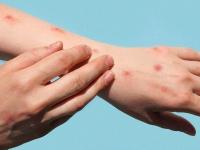 Mpox Outbreak In India: Health Ministry Confirms First Positive Case In the Country - News | Mpox Outbreak In India: Health Ministry Confirms First Positive Case In the Country | Latest health News at Lokmattimes.com