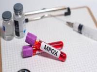 New Mpox Virus Strain Found in China, Following HMPV Outbreak - News | New Mpox Virus Strain Found in China, Following HMPV Outbreak | Latest international News at Lokmattimes.com New Mpox Virus Strain Found in China, Following HMPV Outbreak - News | New Mpox Virus Strain Found in China, Following HMPV Outbreak | Latest international News at Lokmattimes.com