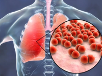 Winter Season Health Care: These Simple Precautions Can Reduce Pneumonia Risk In Cold Months - News | Winter Season Health Care: These Simple Precautions Can Reduce Pneumonia Risk In Cold Months | Latest lifestyle News at Lokmattimes.com Winter Season Health Care: These Simple Precautions Can Reduce Pneumonia Risk In Cold Months - News | Winter Season Health Care: These Simple Precautions Can Reduce Pneumonia Risk In Cold Months | Latest lifestyle News at Lokmattimes.com