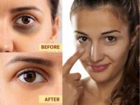 5 Effective Home Remedies to Get Rid of Dark Circles Naturally - News | 5 Effective Home Remedies to Get Rid of Dark Circles Naturally | Latest lifestyle News at Lokmattimes.com 5 Effective Home Remedies to Get Rid of Dark Circles Naturally - News | 5 Effective Home Remedies to Get Rid of Dark Circles Naturally | Latest lifestyle News at Lokmattimes.com