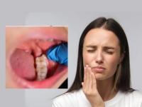 Wisdom Tooth Pain: Causes, Removal, and Home Remedies for Relief - News | Wisdom Tooth Pain: Causes, Removal, and Home Remedies for Relief | Latest health News at Lokmattimes.com Wisdom Tooth Pain: Causes, Removal, and Home Remedies for Relief - News | Wisdom Tooth Pain: Causes, Removal, and Home Remedies for Relief | Latest health News at Lokmattimes.com