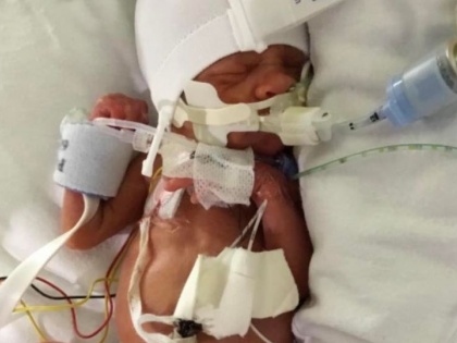 Baby miraculously survives after being born weighing less than a bag of sugar | Baby miraculously survives after being born weighing less than a bag of sugar