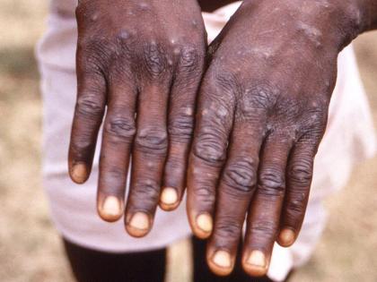 WHO confirms 92 cases of monkeypox across 12 countries, India asked to stay alert | WHO confirms 92 cases of monkeypox across 12 countries, India asked to stay alert
