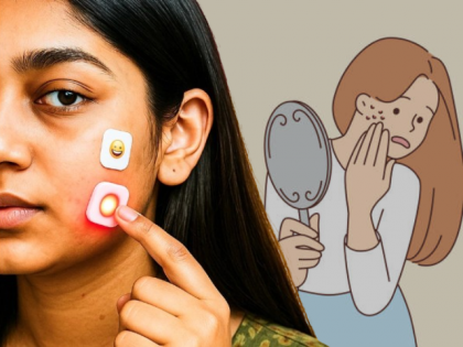 Electric Acne Patches: A Viral Solution To Remove Pimples, but Is It Safe? Here’s What Experts Say | Electric Acne Patches: A Viral Solution To Remove Pimples, but Is It Safe? Here’s What Experts Say Electric Acne Patches: A Viral Solution To Remove Pimples, but Is It Safe? Here’s What Experts Say | Electric Acne Patches: A Viral Solution To Remove Pimples, but Is It Safe? Here’s What Experts Say