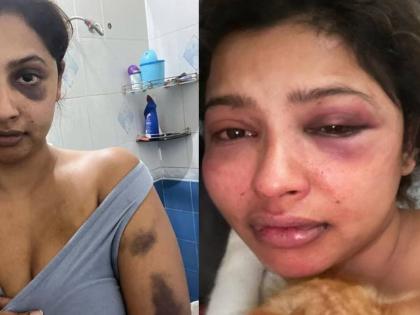 "I was tortured": Actrerss Anicka Vikhraman accuses former boyfriend of physical abuse | "I was tortured": Actrerss Anicka Vikhraman accuses former boyfriend of physical abuse