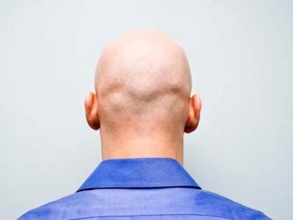Calling a man bald is crime, says British court | Calling a man bald is crime, says British court