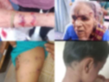 Dog Attack in Pune: Young Boy and 88-Year-Old Woman Seriously Injured in Separate Incidents | Dog Attack in Pune: Young Boy and 88-Year-Old Woman Seriously Injured in Separate Incidents Dog Attack in Pune: Young Boy and 88-Year-Old Woman Seriously Injured in Separate Incidents | Dog Attack in Pune: Young Boy and 88-Year-Old Woman Seriously Injured in Separate Incidents