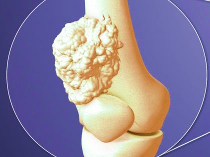 Bone Cancer: Want to Protect Your Bone Health? Start by Noticing These Small Clues | Bone Cancer: Want to Protect Your Bone Health? Start by Noticing These Small Clues Bone Cancer: Want to Protect Your Bone Health? Start by Noticing These Small Clues | Bone Cancer: Want to Protect Your Bone Health? Start by Noticing These Small Clues