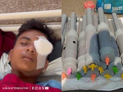 What Is Carbide Gun? Viral ‘Desi Firecracker Gun’ Causes Eye Injuries to 122 Children in Madhya Pradesh | What Is Carbide Gun? Viral ‘Desi Firecracker Gun’ Causes Eye Injuries to 122 Children in Madhya Pradesh What Is Carbide Gun? Viral ‘Desi Firecracker Gun’ Causes Eye Injuries to 122 Children in Madhya Pradesh | What Is Carbide Gun? Viral ‘Desi Firecracker Gun’ Causes Eye Injuries to 122 Children in Madhya Pradesh