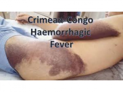 Palghar district on alert over Congo fever; Here's everything you need to know about the deadly Crimean Congo Hemorrhagic Fever | Palghar district on alert over Congo fever; Here's everything you need to know about the deadly Crimean Congo Hemorrhagic Fever