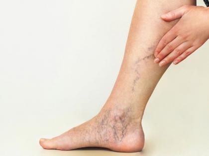 Chronic Venous Insufficiency: Why It Affects People Over 70 and How to Manage | Chronic Venous Insufficiency: Why It Affects People Over 70 and How to Manage