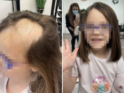 5-year old left partially bald in freak accident while baking cake | 5-year old left partially bald in freak accident while baking cake