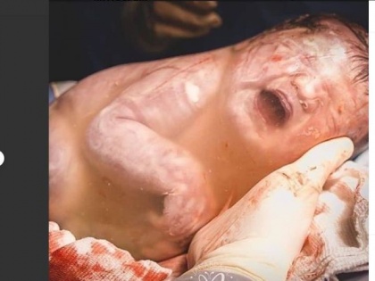 Kashmir sees the first ever reported case of 'En caul' birth | Kashmir sees the first ever reported case of 'En caul' birth