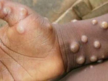 Ghaziabad: Suspected monkeypox patient tests negative | Ghaziabad: Suspected monkeypox patient tests negative Ghaziabad: Suspected monkeypox patient tests negative | Ghaziabad: Suspected monkeypox patient tests negative