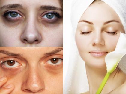 How to Remove Dark Circles at Home: Know Natural Tips and Remedies | How to Remove Dark Circles at Home: Know Natural Tips and Remedies