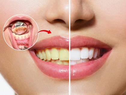 Know Simple Home Remedies For Teeth Whitening | Know Simple Home Remedies For Teeth Whitening Know Simple Home Remedies For Teeth Whitening | Know Simple Home Remedies For Teeth Whitening