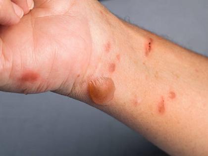Govt issues advisory to states on Tomato Flu | Govt issues advisory to states on Tomato Flu Govt issues advisory to states on Tomato Flu | Govt issues advisory to states on Tomato Flu