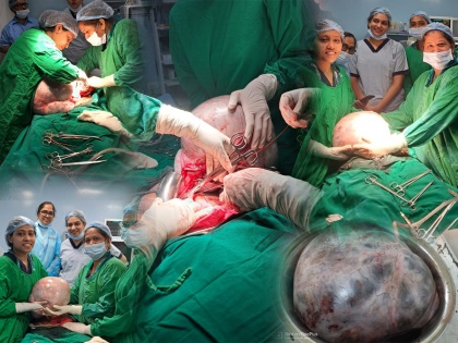Thane: Doctors Remove over 10 kg Cyst from Woman that Made her look Pregnant | Thane: Doctors Remove over 10 kg Cyst from Woman that Made her look Pregnant
