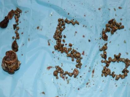 156 kidney stones removed from a patient in Hyderabad | 156 kidney stones removed from a patient in Hyderabad
