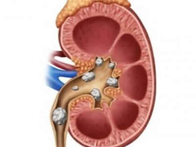 Kidney Stones: High-Oxalate Foods to Avoid for Prevention