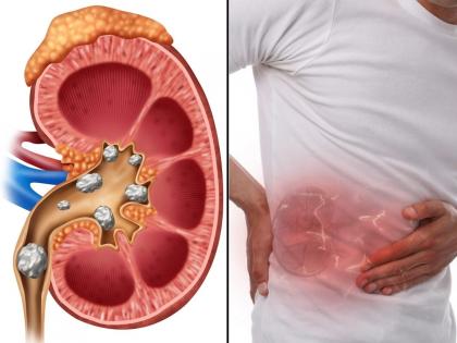 Mumbai Rains Cause Spike in Kidney Stone Cases, Doctors Caution | Mumbai Rains Cause Spike in Kidney Stone Cases, Doctors Caution