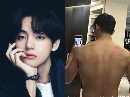 BTS V 's Back Injury Photo on Weverse Sparks Concern Among Fans | BTS V 's Back Injury Photo on Weverse Sparks Concern Among Fans