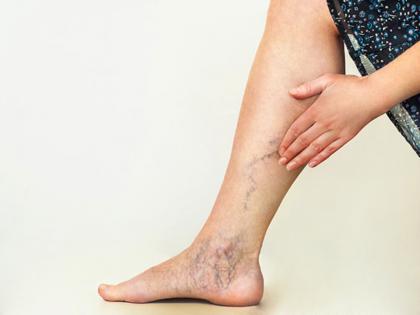 What Your Legs Are Telling You: 5 Symptoms That May Signal Vein Disease | What Your Legs Are Telling You: 5 Symptoms That May Signal Vein Disease What Your Legs Are Telling You: 5 Symptoms That May Signal Vein Disease | What Your Legs Are Telling You: 5 Symptoms That May Signal Vein Disease