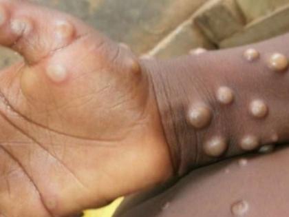 Ministry of health and family welfare releases common symptoms and precautions of Monkeypox | Ministry of health and family welfare releases common symptoms and precautions of Monkeypox