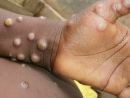 India reports second positive case of Monkeypox in Kerala | India reports second positive case of Monkeypox in Kerala