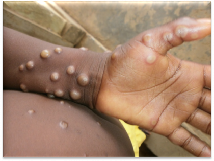 Delhi reports its first case of monkeypox; overall fourth case in India | Delhi reports its first case of monkeypox; overall fourth case in India